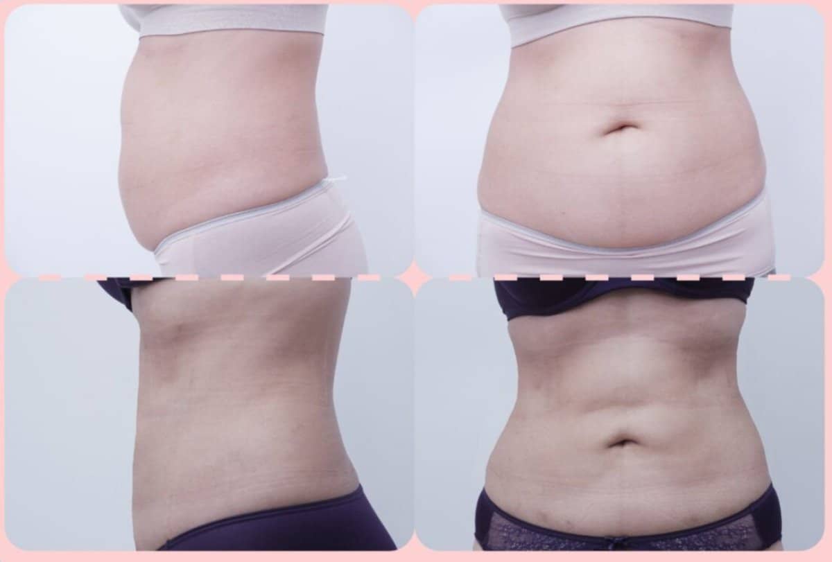 Case 20532 - abdominal liposuction