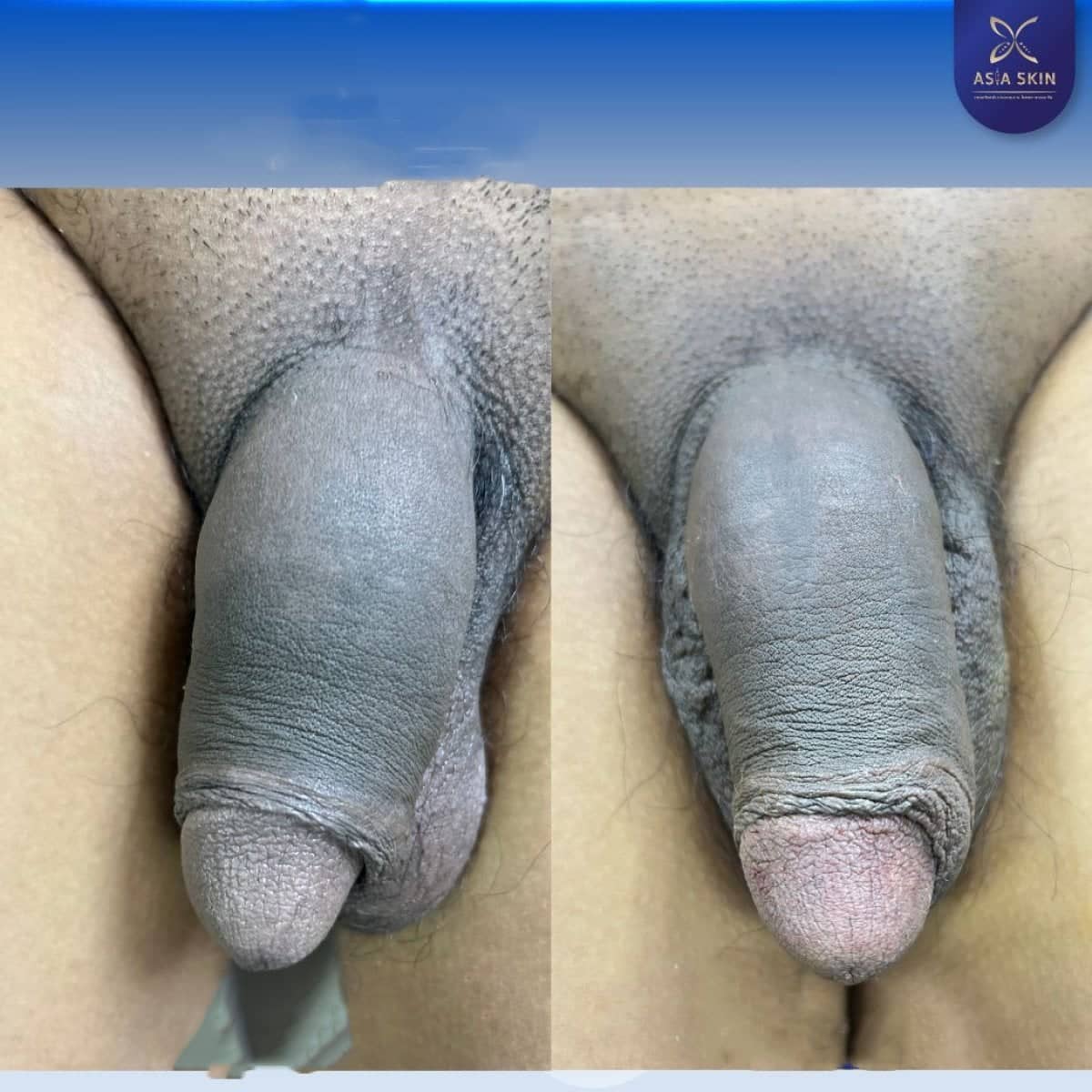 Case 20534 - penis enlargement