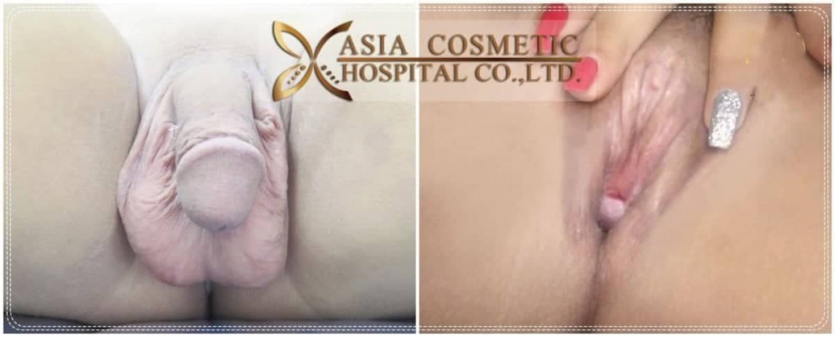 Case 20535 - vaginoplasty