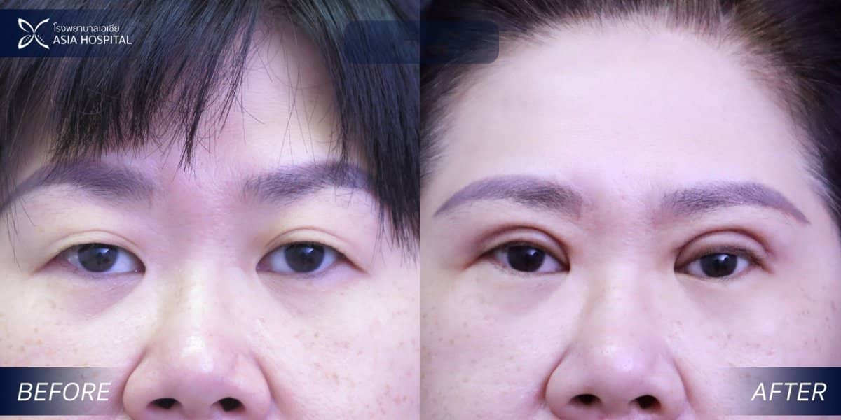 Case 20537 - blepharoplasty