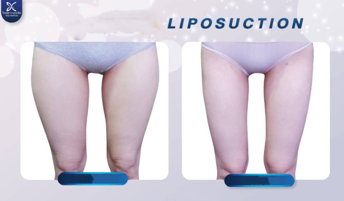 Case 20538 - thigh liposuction
