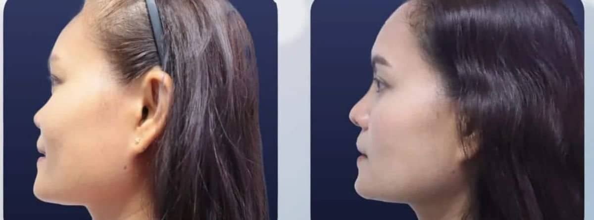 Case 20540 - tip rhinoplasty