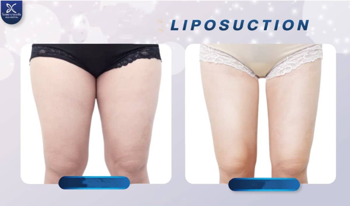 Case 20541 - thigh liposuction