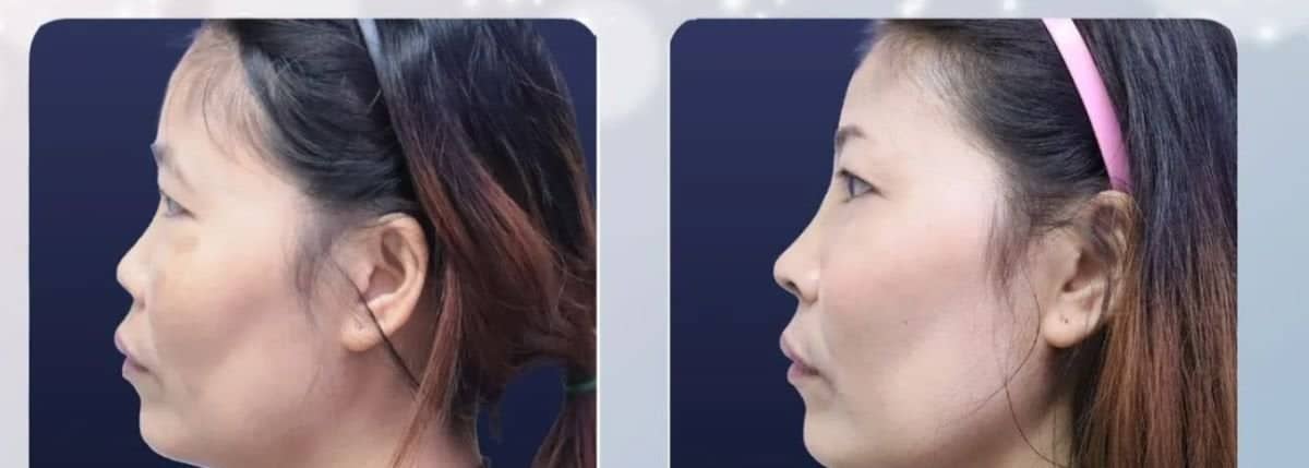 Case 20543 - tip rhinoplasty