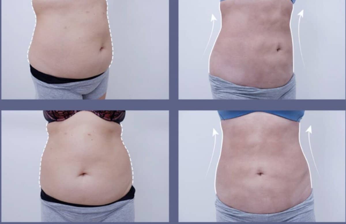 Case 20545 - abdominal liposuction