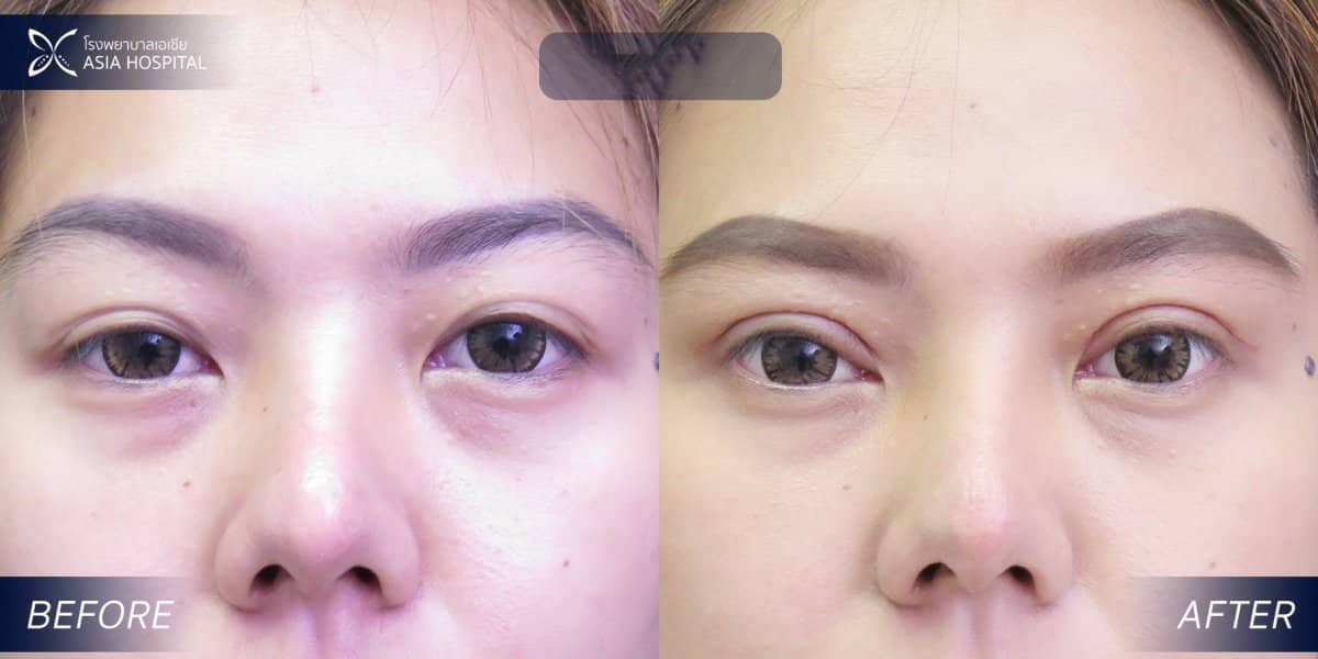 Case 20549 - blepharoplasty