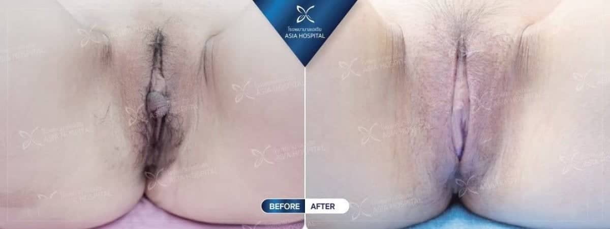 Case 20550 - labiaplasty