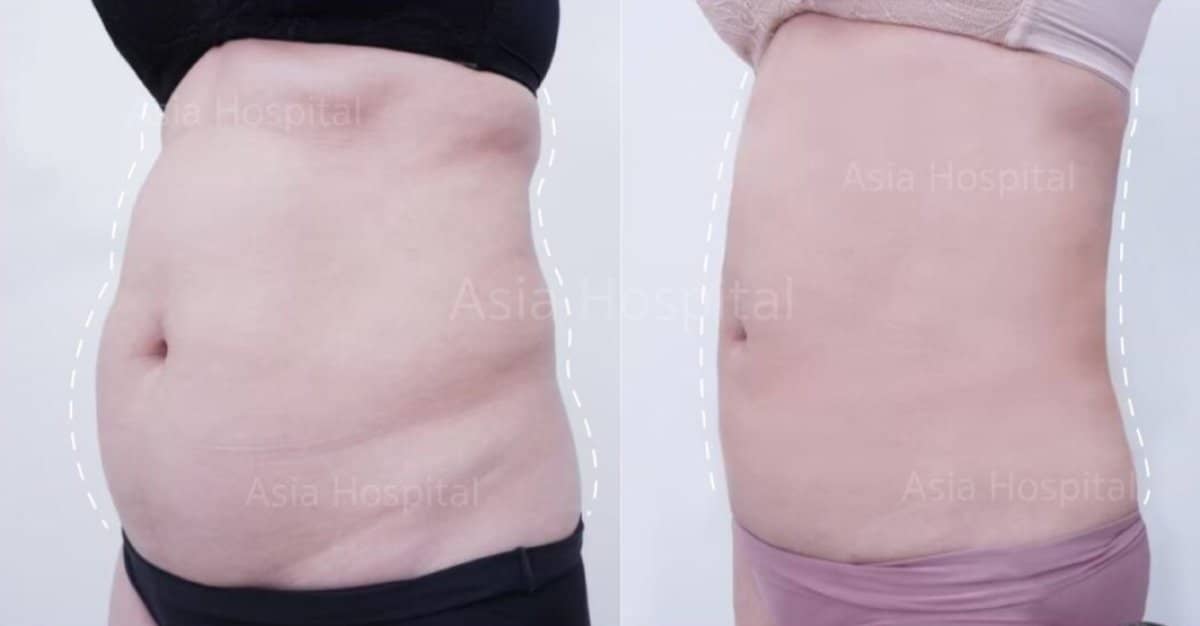 Case 20556 - abdominal liposuction