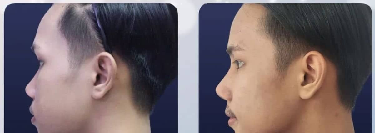 Case 20557 - tip rhinoplasty