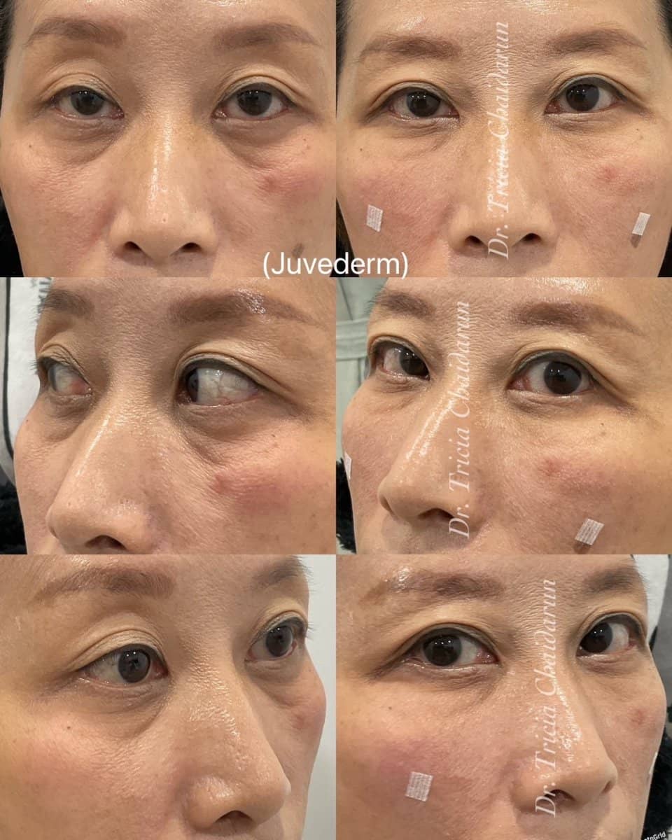Case 20560 - Juvederm fillers injection