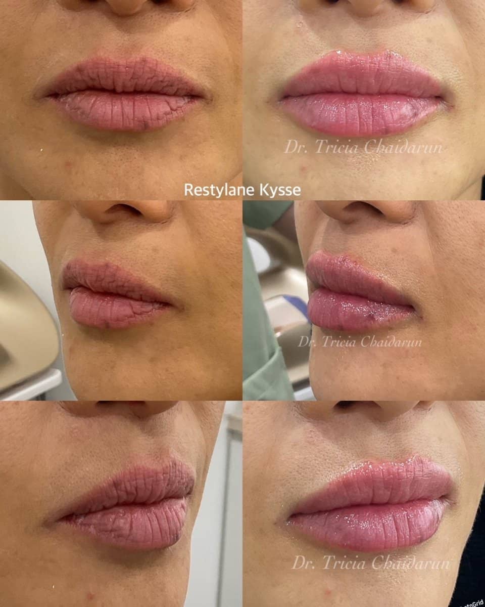 Case 20561 - lip fillers injection
