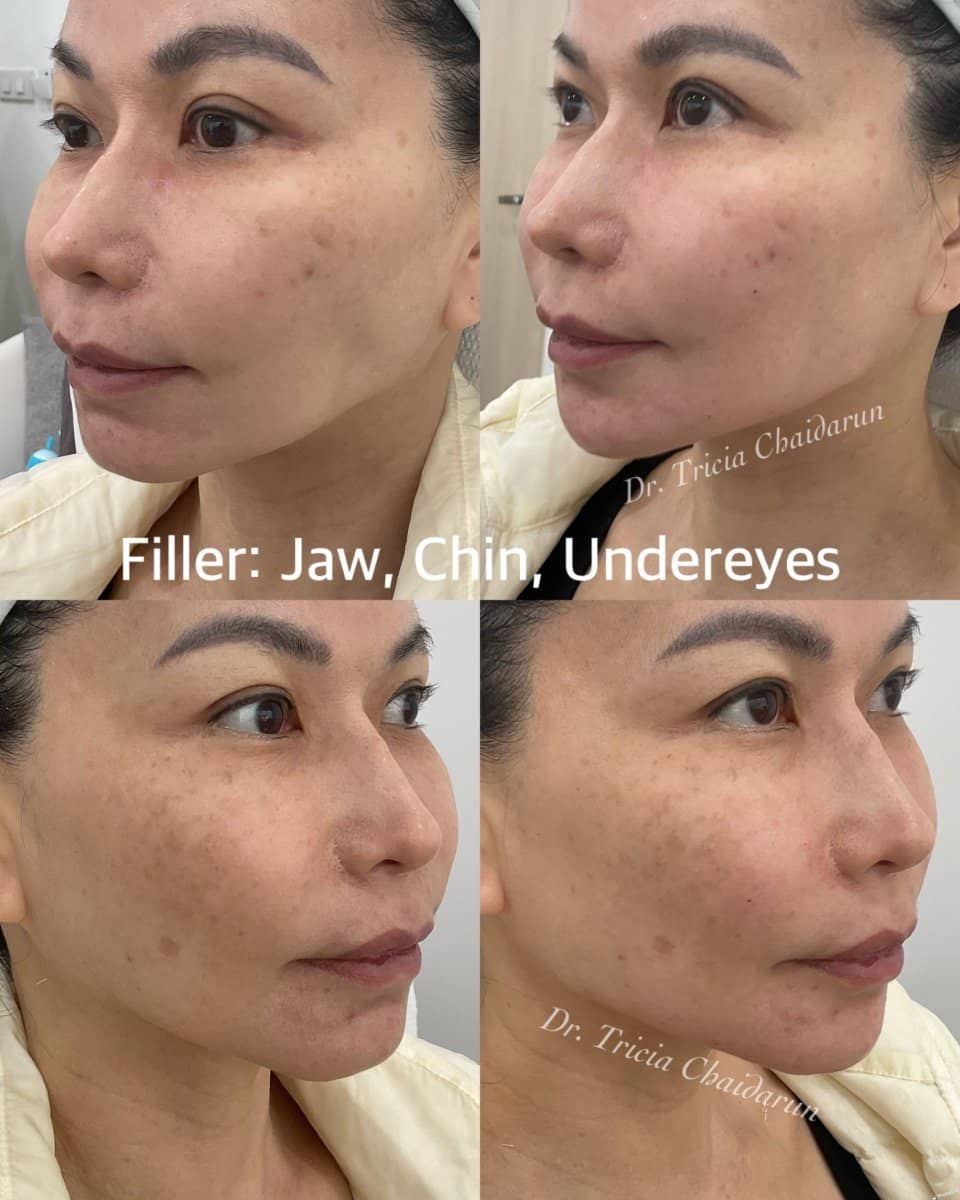 Case 20562 - fillers for jaw, chin, undereyes