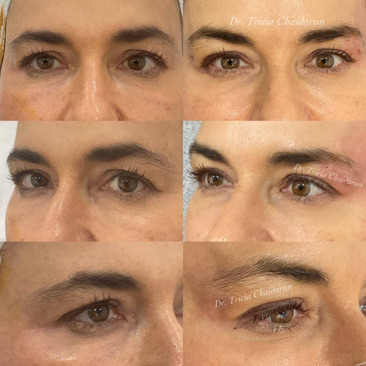 Case 20563 - Botox injections