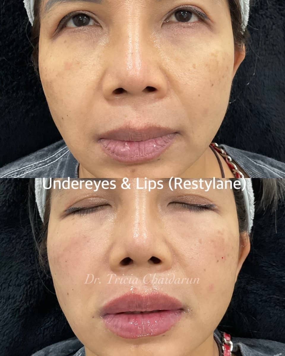 Case 20565 - Restylane fillers for undereyes and lips
