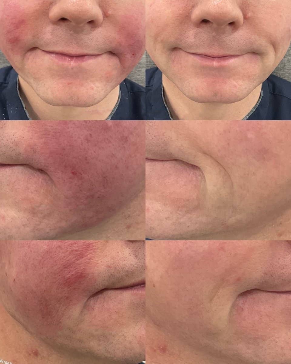 Case 20566 - fillers injection