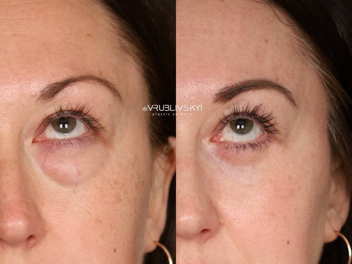 Case 20569 - blepharoplasty