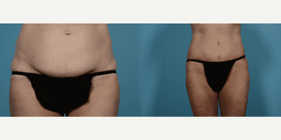 Case 2057 - 55-64 year old woman treated with Tummy Tuck