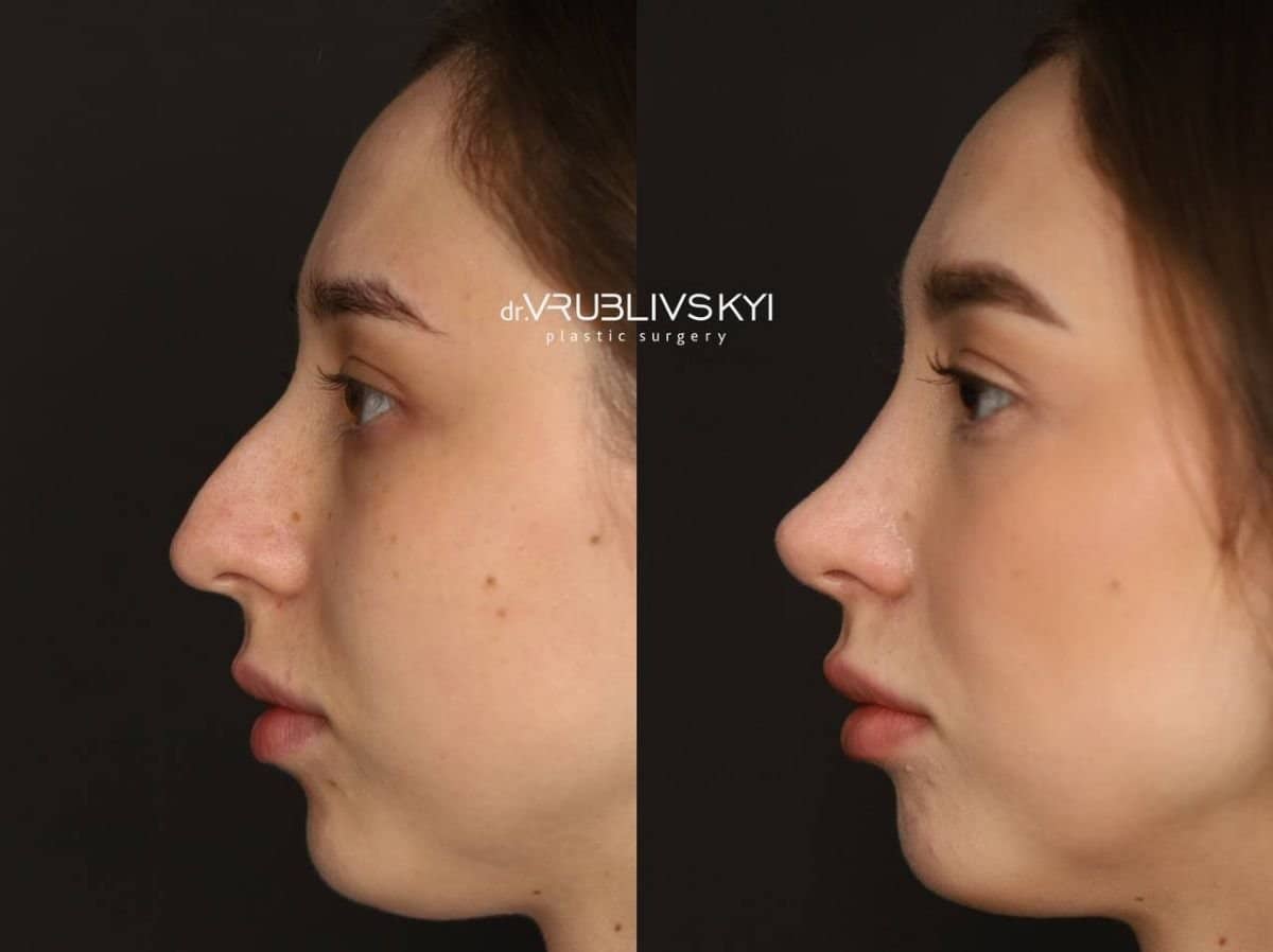 Case 20571 - rhinoplasty