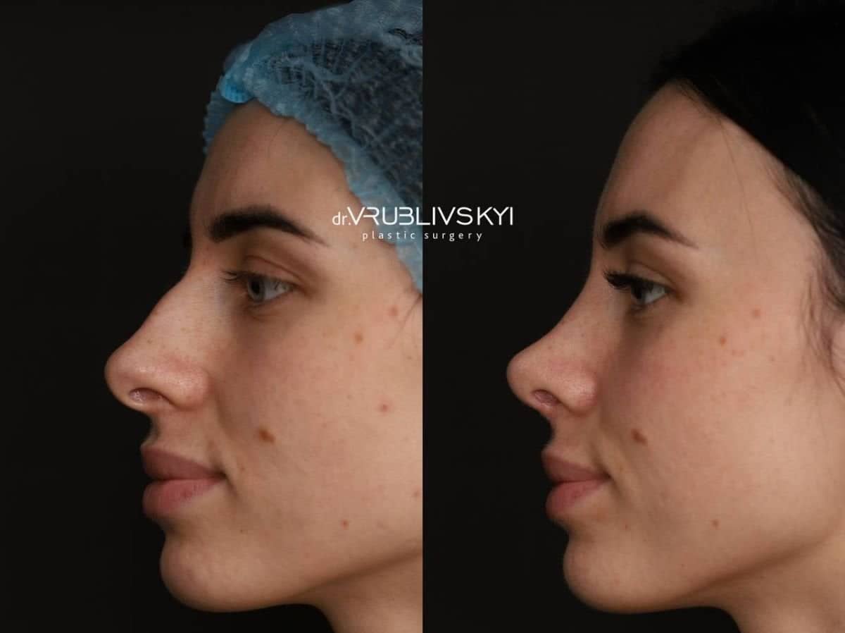 Case 20574 - rhinoplasty
