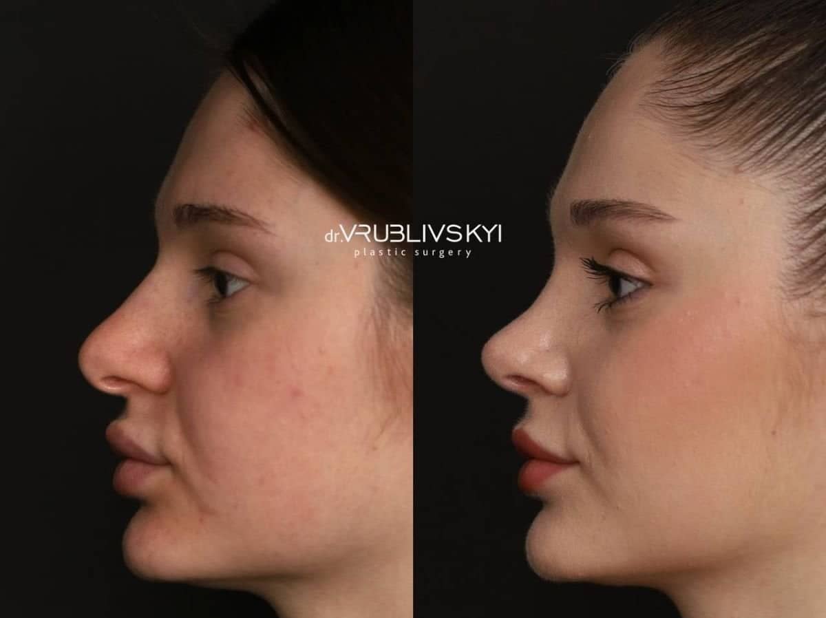 Case 20575 - rhinoplasty