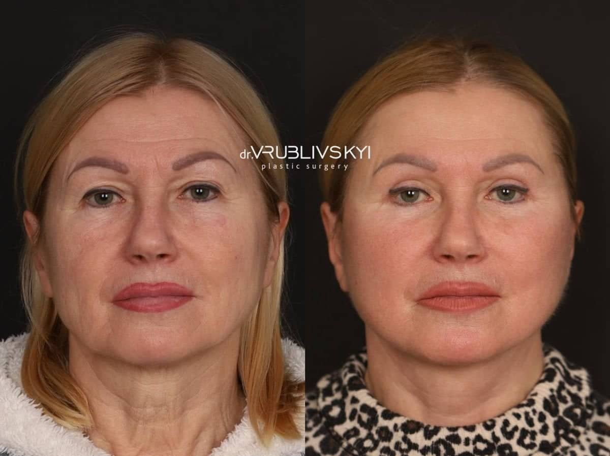 Case 20576 - results