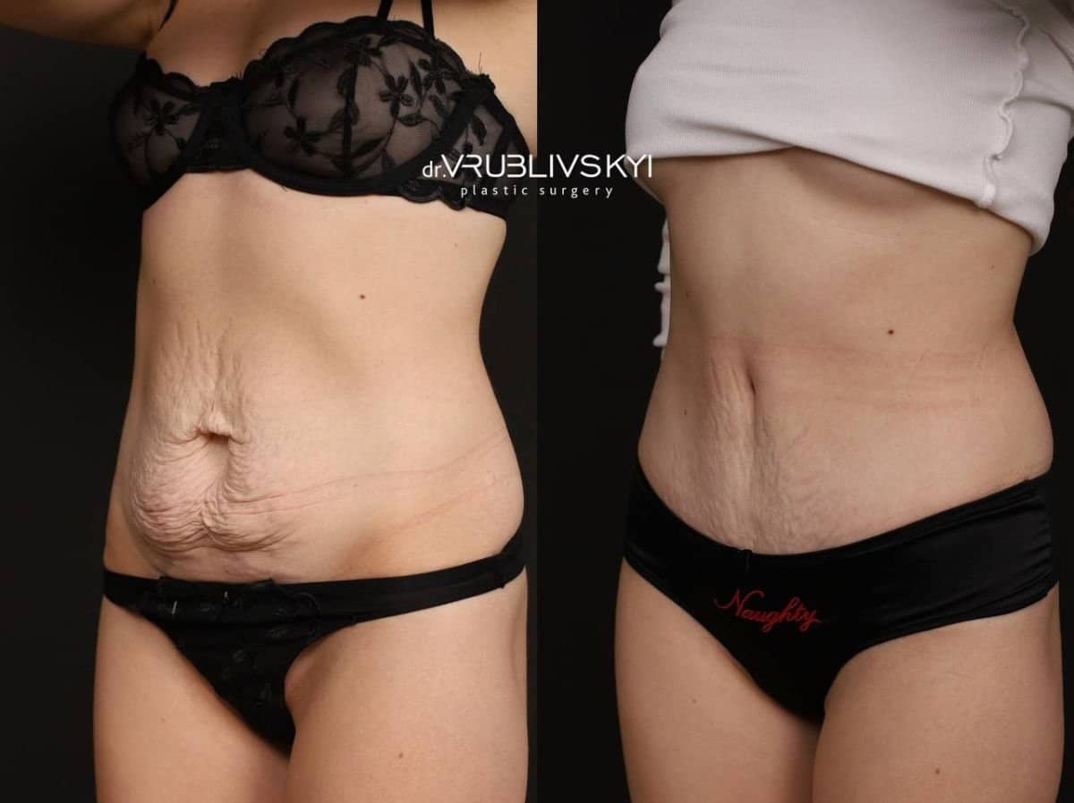 Case 20577 - tummy tuck