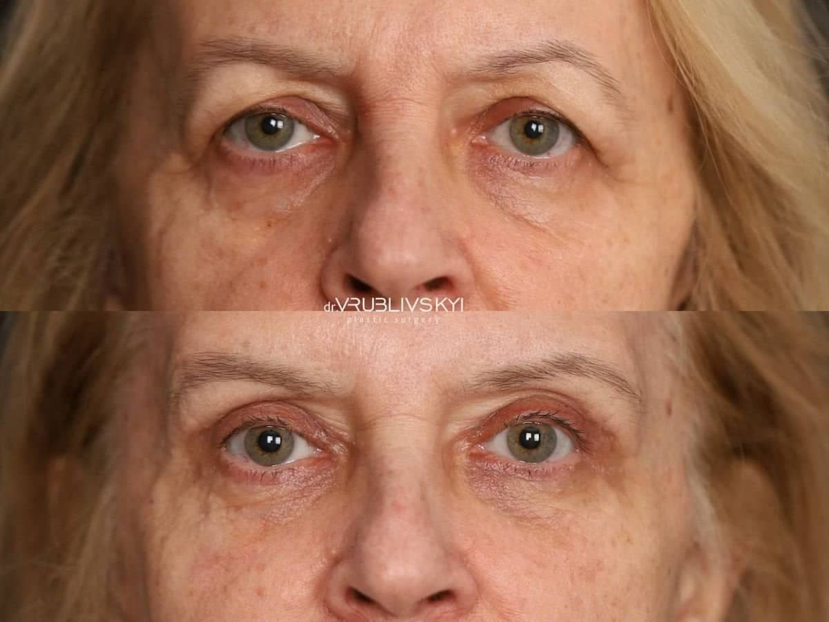 Case 20578 - blepharoplasty