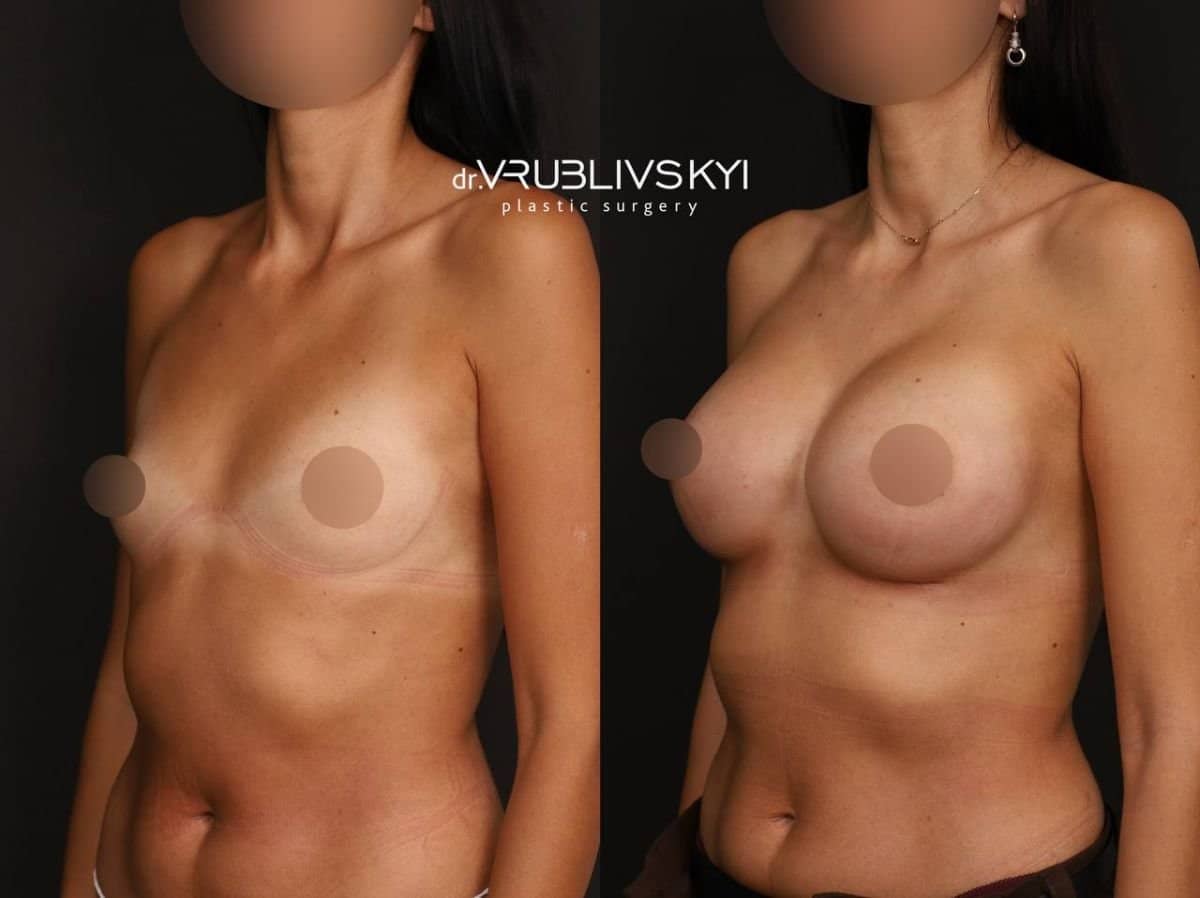 Case 20579 - mammoplasty