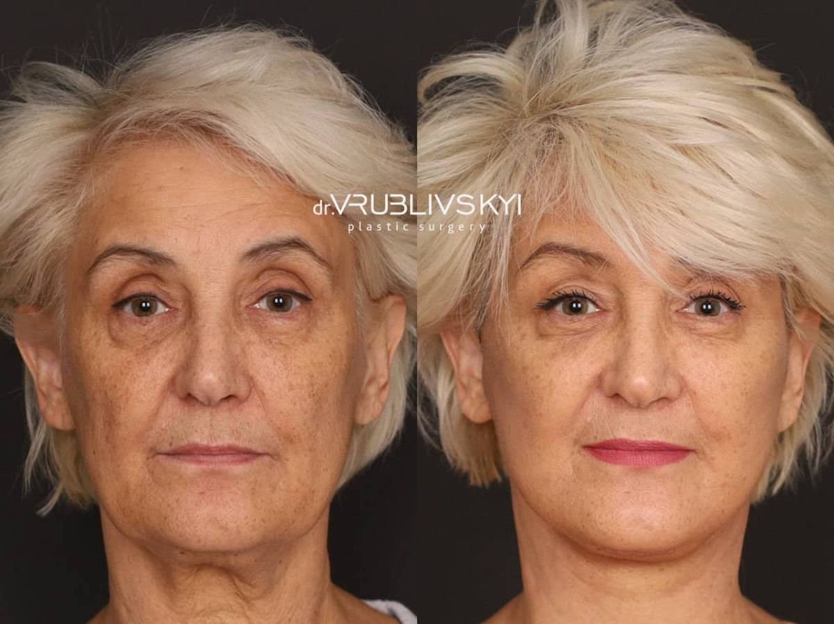 Case 20580 - results