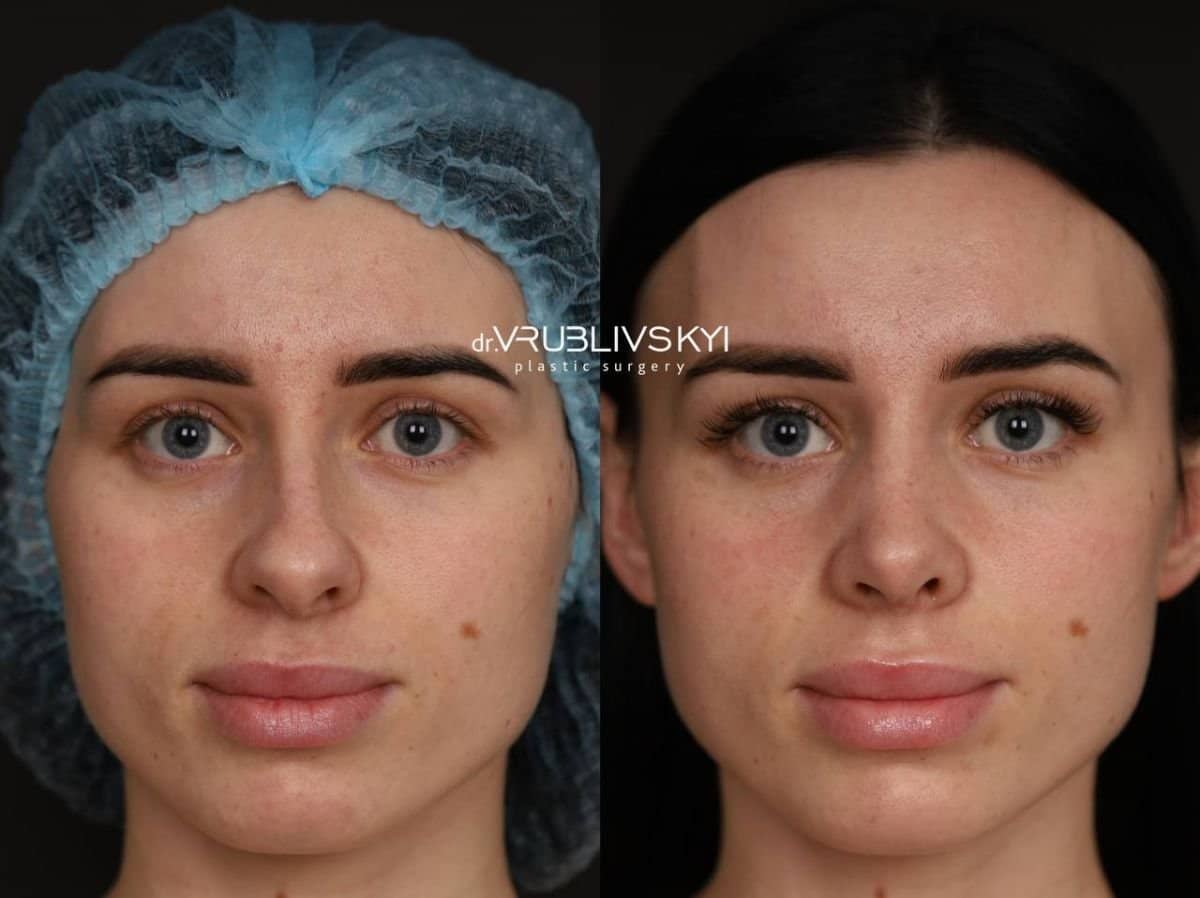 Case 20581 - rhinoplasty
