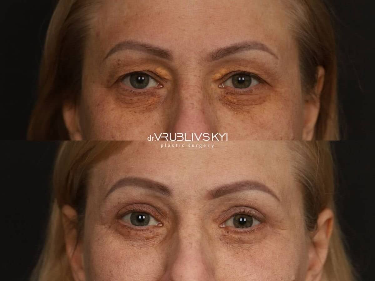 Case 20583 - blepharoplasty