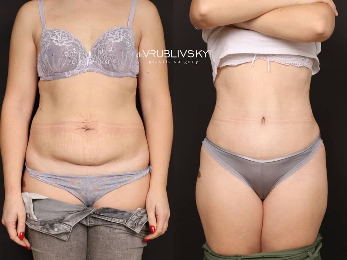 Case 20586 - tummy tuck