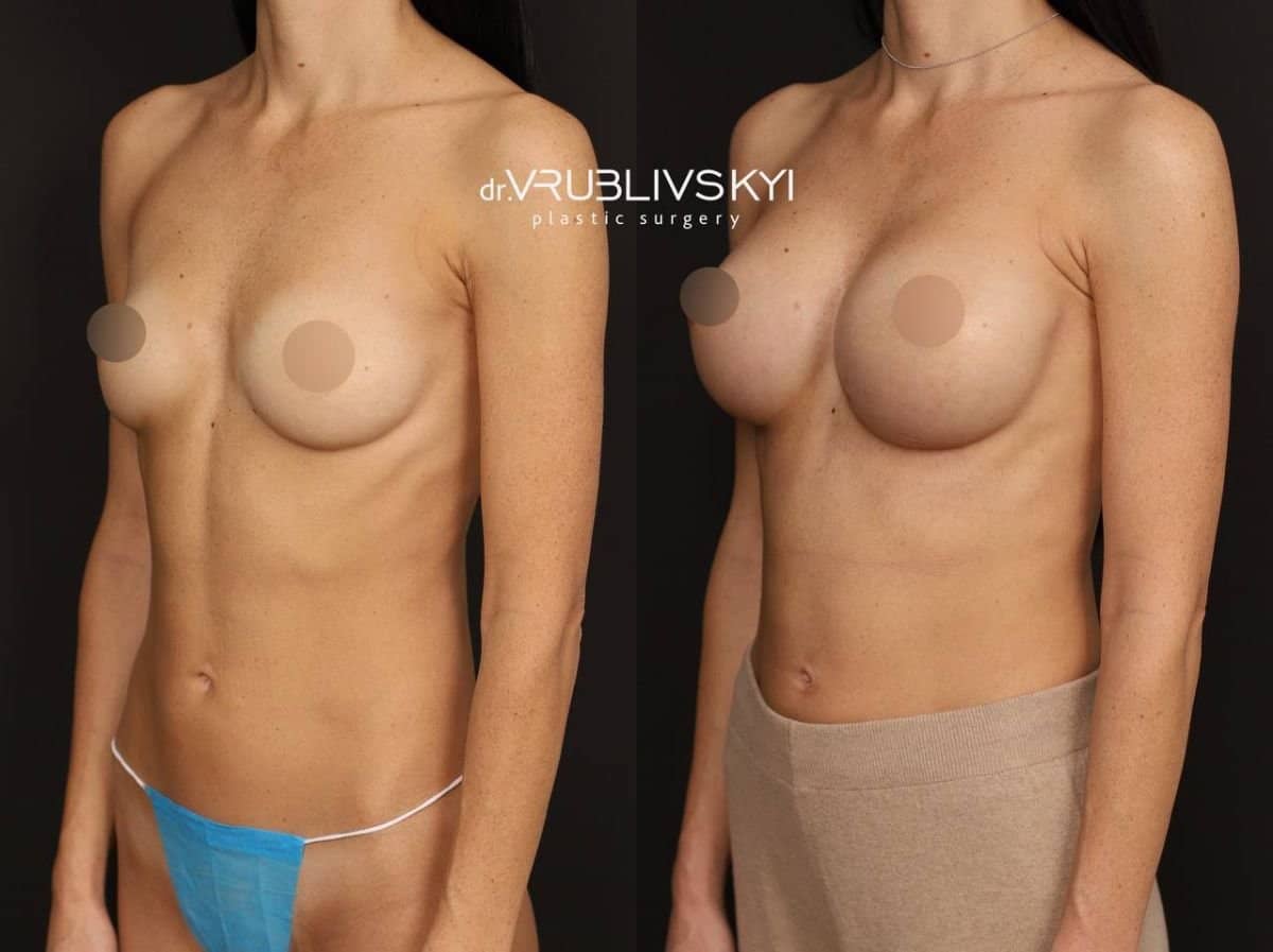Case 20587 - mammoplasty