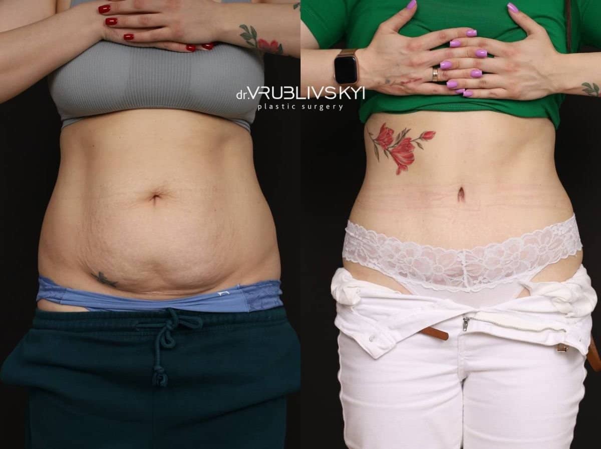 Case 20590 - tummy tuck