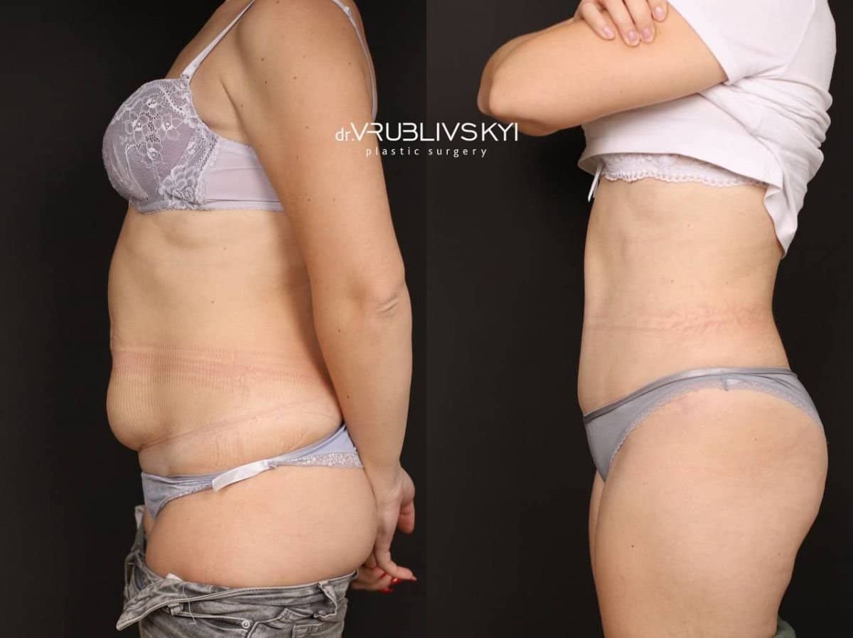 Case 20598 - liposuction