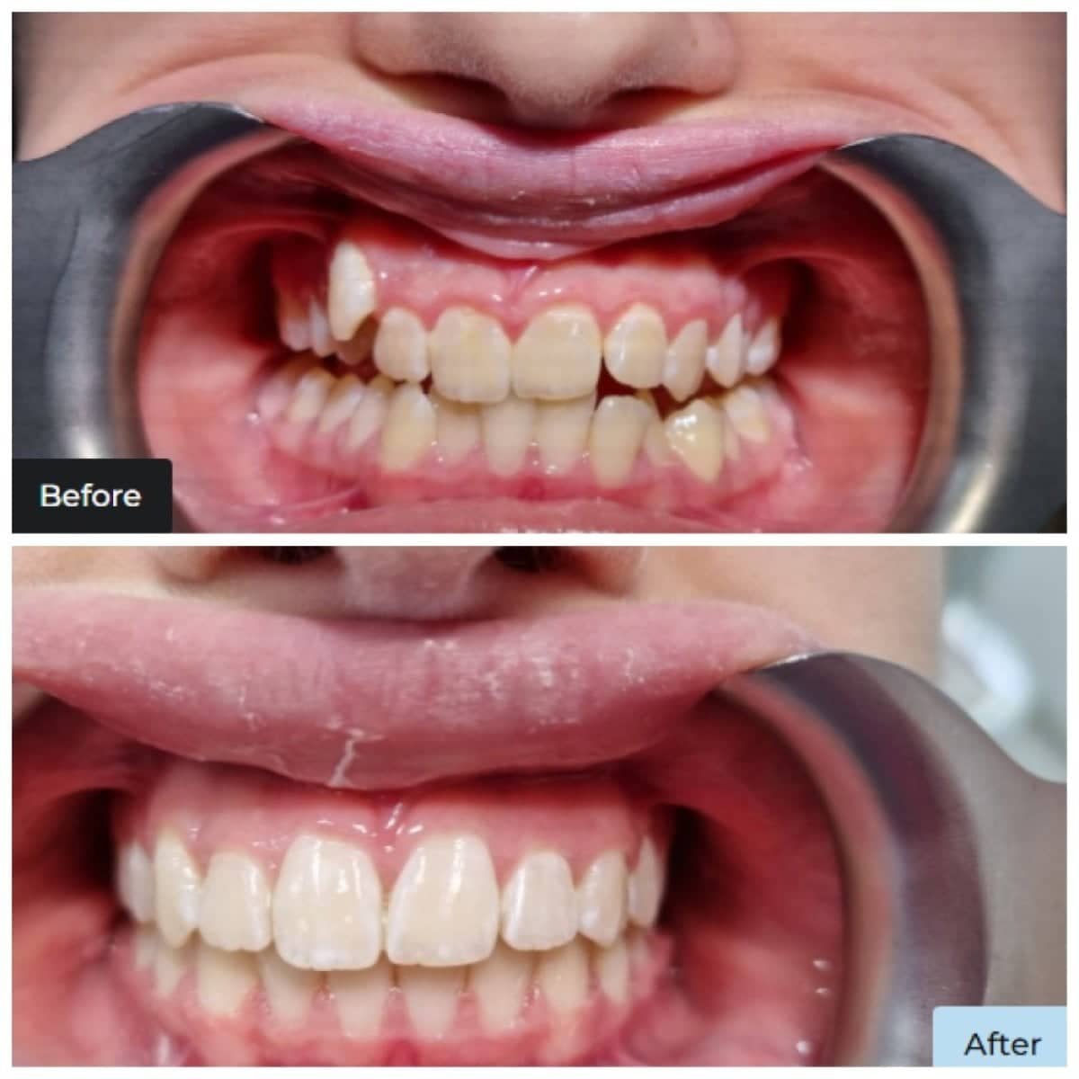 Case 20632 - clear aligners