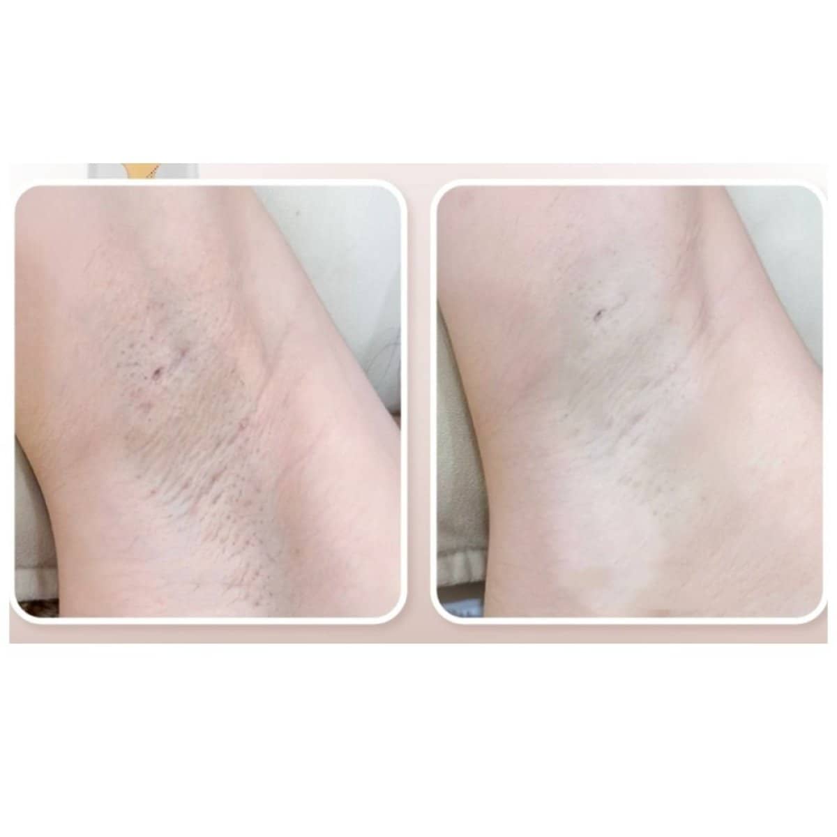Case 20642 - laser hair removal