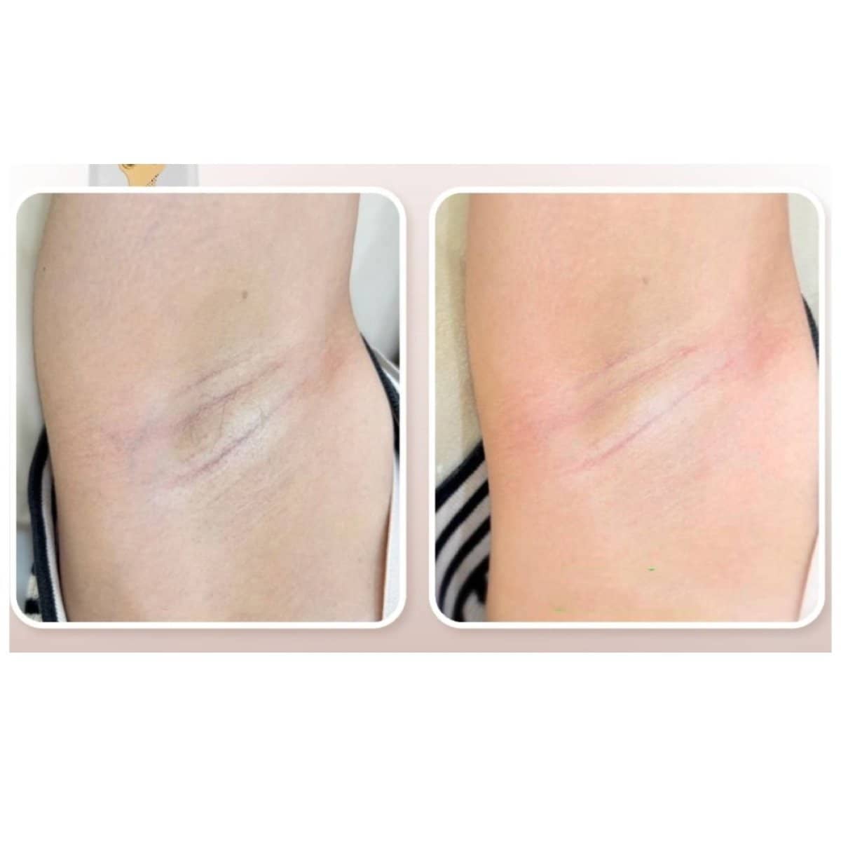 Case 20651 - laser hair removal