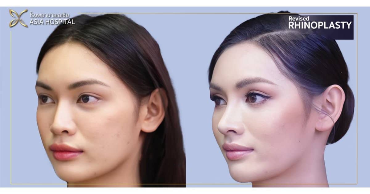 Case 20704 - revised rhinoplasty