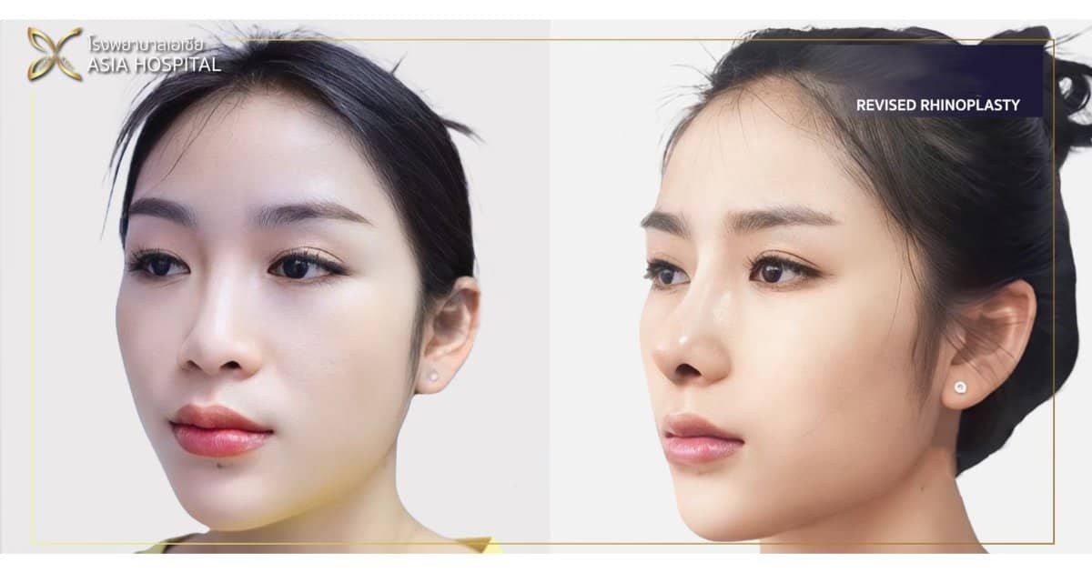 Case 20705 - revised rhinoplasty