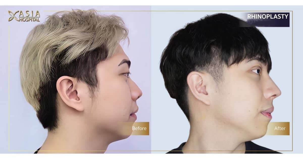 Case 20708 - rhinoplasty