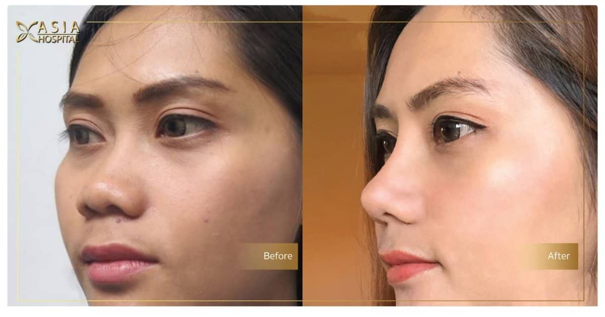 Case 20709 - open rhinoplasty