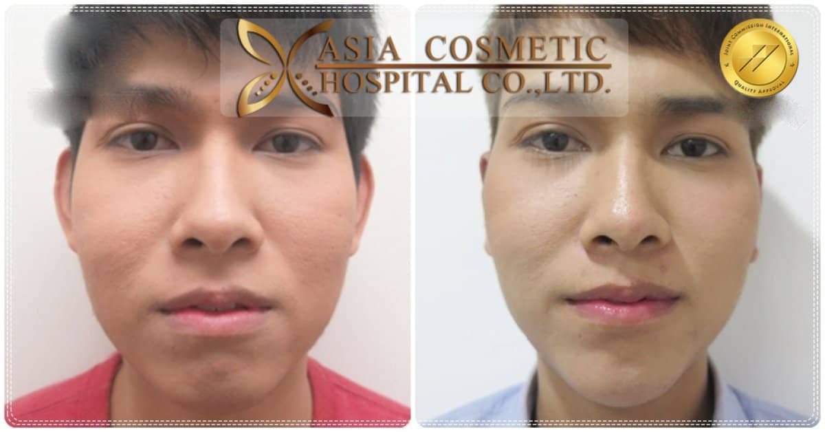 Case 20713 - otoplasty