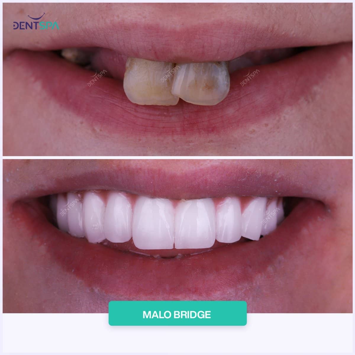 Case 20719 - Malo Bridge dental restoration