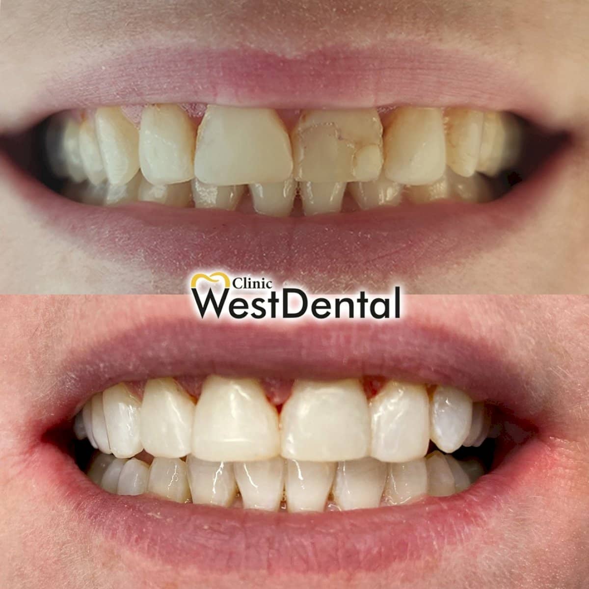 Case 20720 - composite veneer