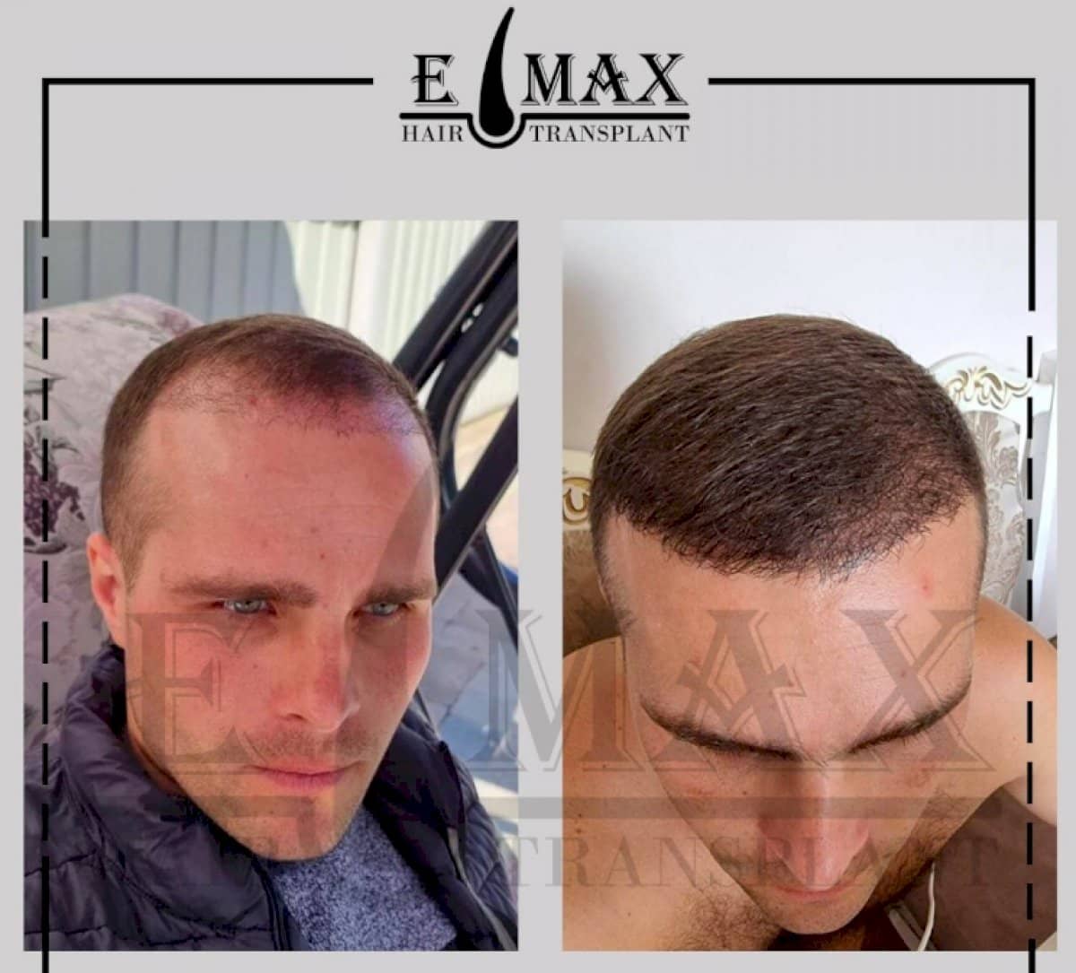 Case 20754 - FUE hair transplant