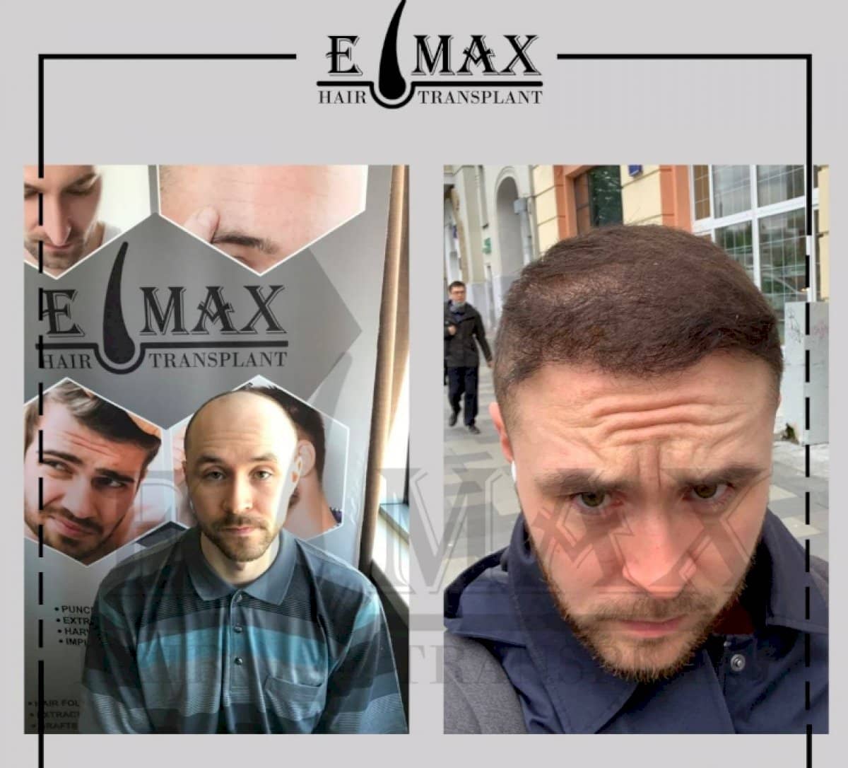 Case 20755 - FUE hair transplant