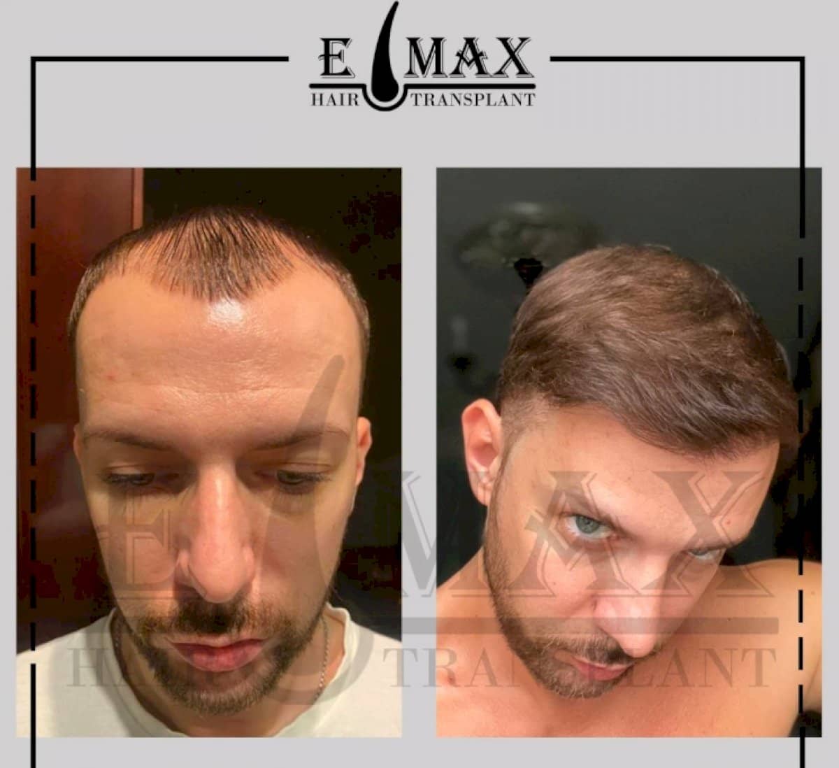 Case 20756 - FUE hair transplant