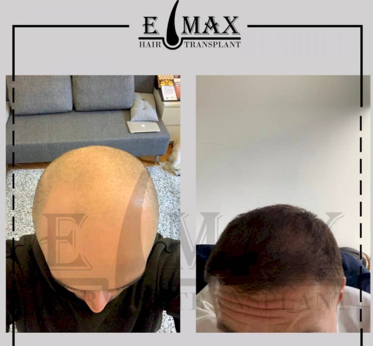 Case 20757 - DHI hair transplant