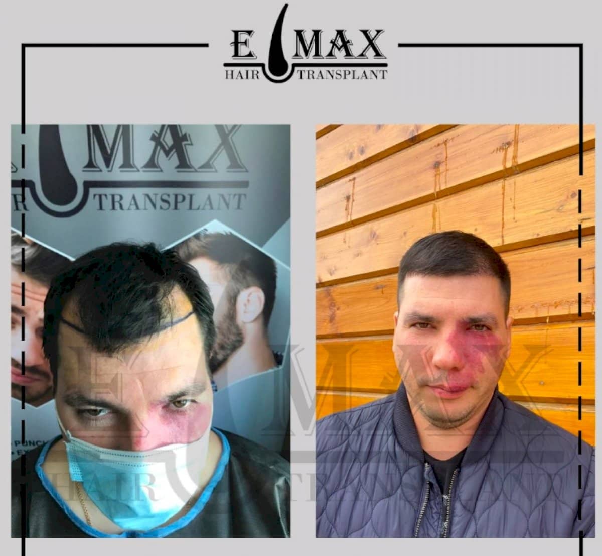 Case 20758 - DHI hair transplant